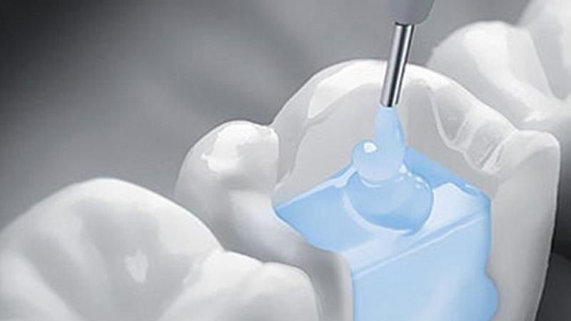 Dişi kariesdən qoruyan "ömürlük" plomb kəşf edildi