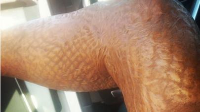 Bədəni yanan qadın 14 il sonra  hamilə qarnını nümayiş etdirdi - - FOTOLAR