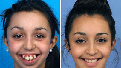 Bir vaxtlar üzündən utanan qız gözəllik kraliçası olacaq - FOTOLAR