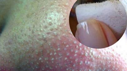 Cəmi 1 vasitə ilə dəridəki qara nöqtələrdən azad olun