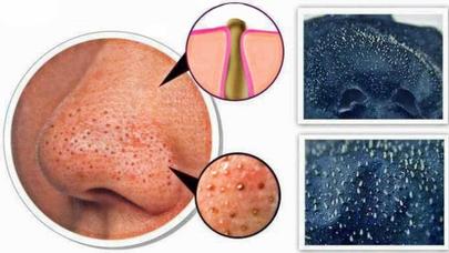 Qara nöqtələri təmizləyən ƏN UCUZ vasitə