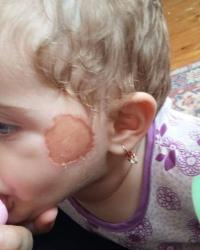 Gəncədə uşaq bağçasında VƏHŞİLİK: Tərbiyəçi 1 yaş 6 aylıq qızın üzünü dağladı - FOTO