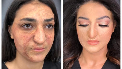 Dünyaya səs salan azərbaycanlı vizajist üzü yanmış xanımı TANINMAZ HALA SALDI - VİDEO