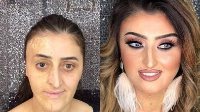 Azərbaycanda üzü tamamilə yanan qızın İNANILMAZ DƏYİŞİMİ - Hamı MAT QALDI (FOTO)