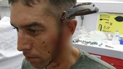 Başına 15 santimetrlik bıçaq saplanan kişi hamını DƏHŞƏTƏ GƏTİRDİ: həkimə piyada getdi və... - - FOTO