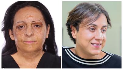 Azərbaycanlı vizajist üzü yanmış qadını TAMAMİLƏ DƏYİŞDİ – VİDEO