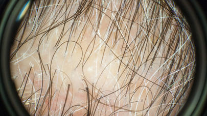 Sümük iliyinin bu günə qədər bilinməyən FAYDASI - Buxarla qızdırılaraq...