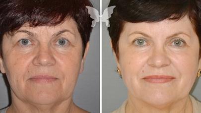 20 yaş gəncləşdirən maska