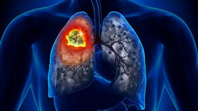 Ölümcül ağciyər xəstəliyinin səbəbi açıqlandı