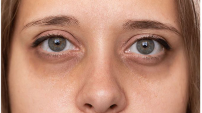 Gözaltı qaralmaları yaradan səbəblər - Ehtiyatlı olun