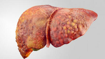 Qaraciyər piylənməsindən dərmansız xilas yolu: ABŞ alimləri "oruc tutun" deyirlər