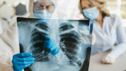 Azərbaycanda vərəm təhlükəsi -  AÇIQLAMA