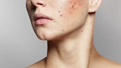 Sızanaqların artmasına nə səbəb olur?