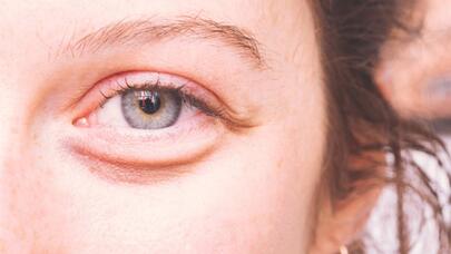 Gözaltı torbalardan əziyyət çəkənlər üçün 6 üsul