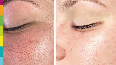 Kosmetoloq qara nöqtələrə qarşı ən təsirli vasitələri açıqladı
