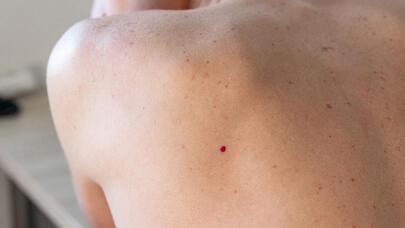 Dermatoloq dəridə qırmızı nöqtələrin yaranma səbəblərini açıqladı
