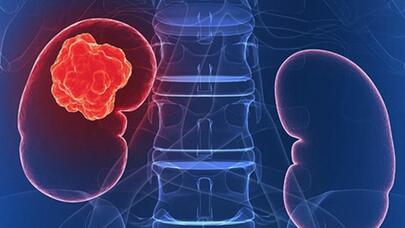 Böyrəklər üçün POTENSİAL TƏHLÜKƏ TAPILDI