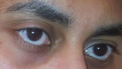 Göz ətrafında qara halqaların yaranmasına səbəb nədir?