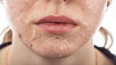 Kran suyu niyə dərini qurudur və qıcıqlandırır?