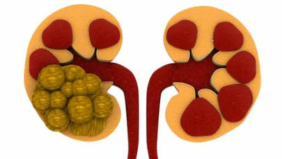 Böyrək daşlarının TƏHLÜKƏLİ ƏLAMƏTLƏRİ: "Ağrılara dözmək olmaz, çünki..."