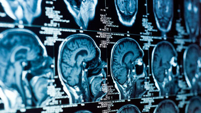 Daha çox insanı insultdan belə qorumaq olar: ilk 45 dəqiqə ərzində...