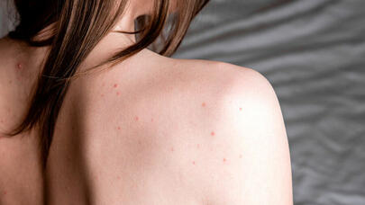 Sızanaqlardan qurtulmağın sadə yolu tapıldı