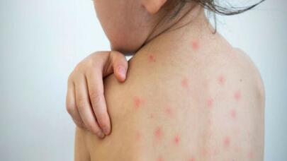 Bakıda sığınacaqda 40 uşaq qızılcaya yoluxdu