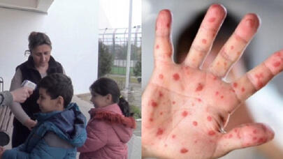 Qızılca xəstəliyinin yayılması çoxalıb - VİDEO