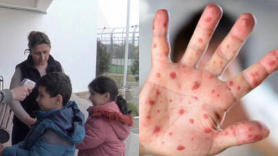 Qusarda qızılca sürətlə yayılır - VİDEO