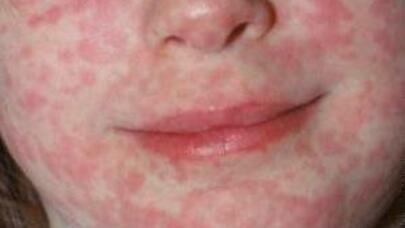 Dünyanın “üzünü qızardan” qızılcadan Azərbaycan üzüağ çıxacaq? - Bu şəxslər... 