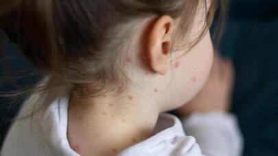 Ölkədə qızılca ilə bağlı vəziyyət nə yerdədir? - TƏBİB rəhbərindən AÇIQLAMA