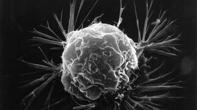 Kimyaterapiyaya alternativ xərçəng müalicəsi tapıldı: "Molekulyar qırıcılar"