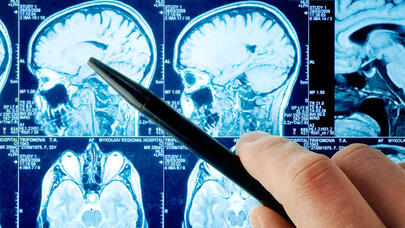 Bu vitamin dağınıq sklerozun dərmanı hesab olunur