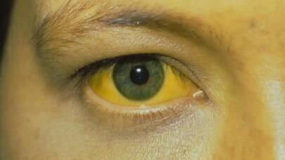 Bakıda bu xəstəlik də yayılmağa başladı - PEYVƏND TƏLƏB OLUNUR 