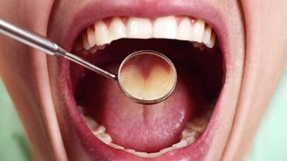 Boğazda xroniki ağrı xərçəng əlaməti ola bilər