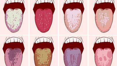 Dilin rəngi bu xəstəliklərdən xəbər verir- FOTO