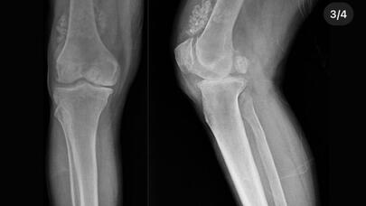 Xəstənin dizindən 41 "oynaq siçanı" çıxarıldı - FOTO