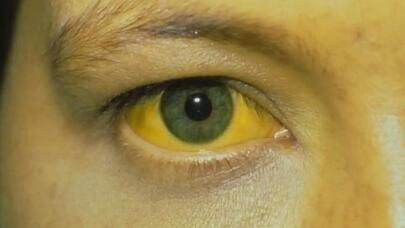 Bakıda sarılıq təhlükəsi: Yoluxanların sayı çoxalır - VİDEO