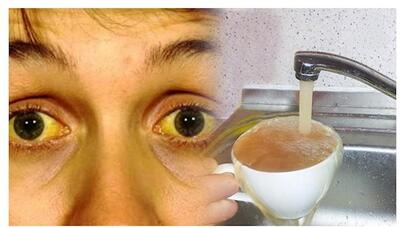 Azərbaycanı "sarılıq" xəstəliyi bürüyüb: Necə qorunaq?