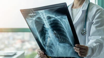 50 yaşdan yuxarı şəxslərin diqqətinə: ağciyər xərçəngi riski...