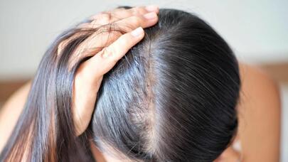 Qadınlarda dazlaşma - Səbəbləri