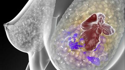 Süd vəzi xərçənginin ilkin əlamətləri nələrdir?