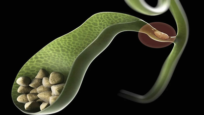 Öd kisəsindəki daşlar xərçəngə səbəb olur?