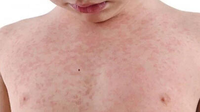 Bu rayonda 10 gün ərzində 83 nəfər qızılcaya yoluxdu