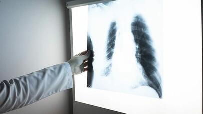 Həkim son zamanlar geniş yayılan vərəm xəstəliyindən danışdı