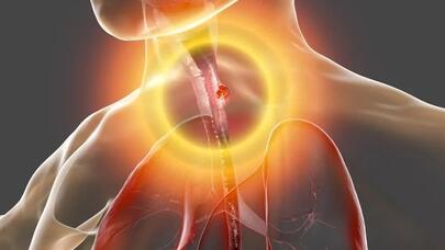 Qripə yoluxduğunu düşünürdü, ölümcül xərçəng olduğu ortaya çıxdı