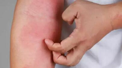 Gecə qəflətən başlayan qaşıntı nəyə işarədir? – SƏBƏBLƏR