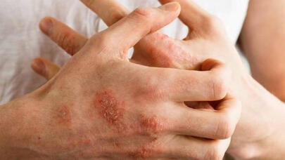 Yazda hansı dəri problemləri yaranır? - 3 önləyici TƏDBİR