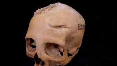 Sübut edildi: Qədim Misirdə xərçəng şişləri cərrahi yolla çıxarılıb