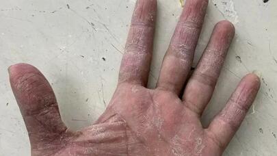 Ovucda üzə çıxan xəstəlik əlaməti – Bunu görən kimi həkimə müraciət edin!